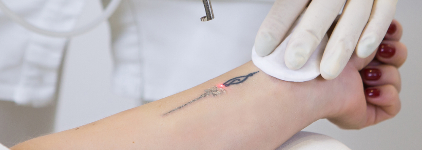Cara Merawat Luka Bekas Hapus Tato Agar Cepat Pulih